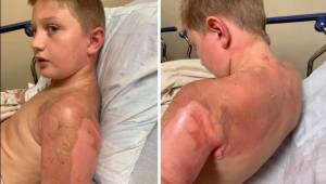 11-letni chłopiec obudził się z przerażającymi poparzeniami po tym jak jego kole
